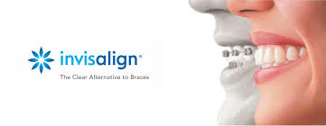 Invisalign - Teeth straightening